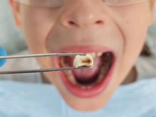 Best Emergency Tooth Extraction in Machesney Park, IL